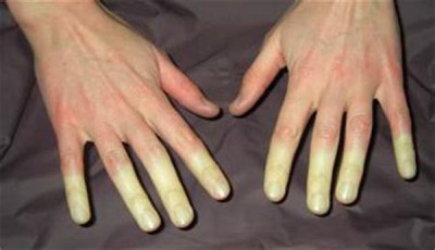 Болезнь Рейно любит тепло