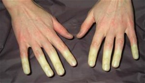 Болезнь Рейно любит тепло