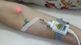 Для чего нужно внутривенное лазерное облучение крови Для чего нужно внутривенное лазерное облучение крови