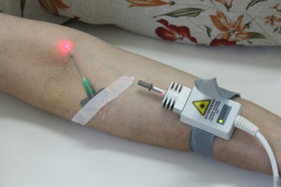 Для чего нужно внутривенное лазерное облучение крови