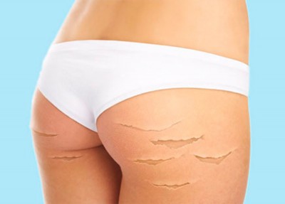 Как удалить растяжки на коже