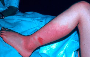 Лечение рожи ультрафиолетом