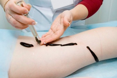 Мифы и факты о лечении пиявками