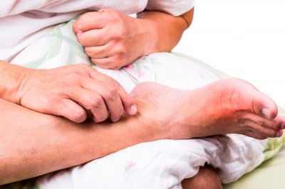 Подагра – болезнь королей