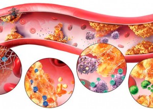 Учёные всего мира бьют тревогу – атеросклероз выявляют даже у детей и подростков