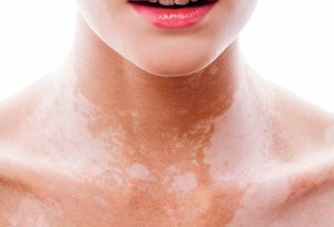 Витилиго. Как сделать пятна на коже менее заметными.