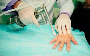 Выведение бородавок жидким азотом